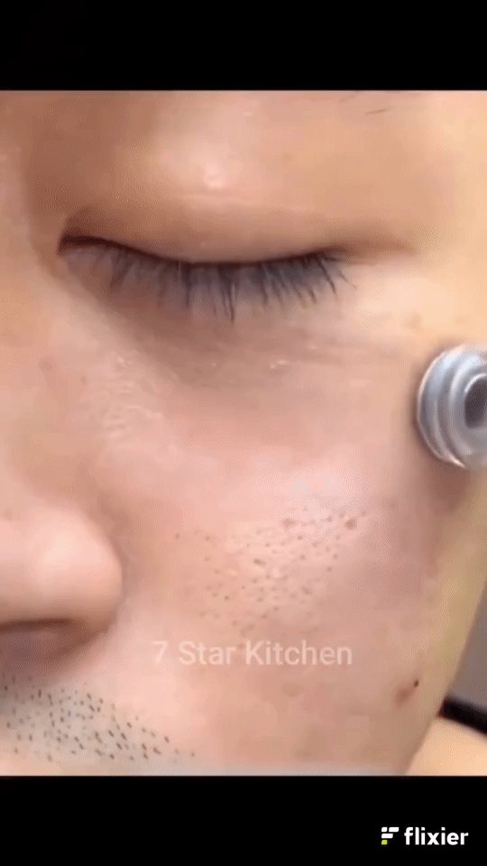 Instant Blackhead Remover Vacuum – Deep Clean Pores in Minutes | 4-in-1 Skin Tool
